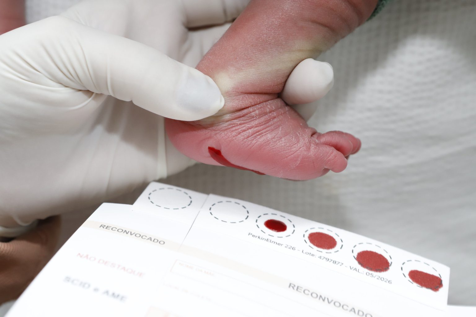 Galactosemia detectada pelo teste do pezinho leva a acompanhamento multidisciplinar no HAB de Brasília
